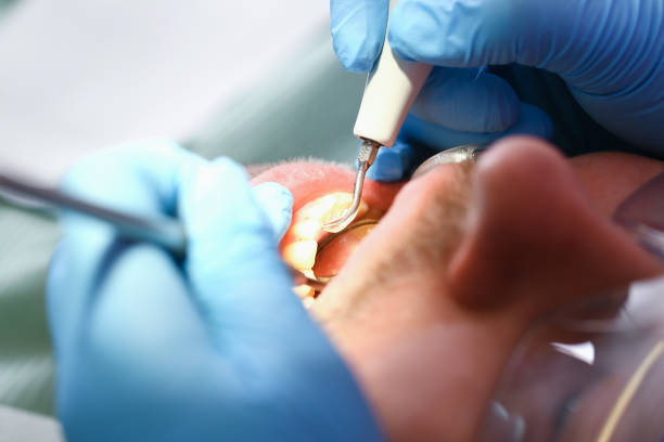 Best Emergency Dental Extractions in Sheridan, IN